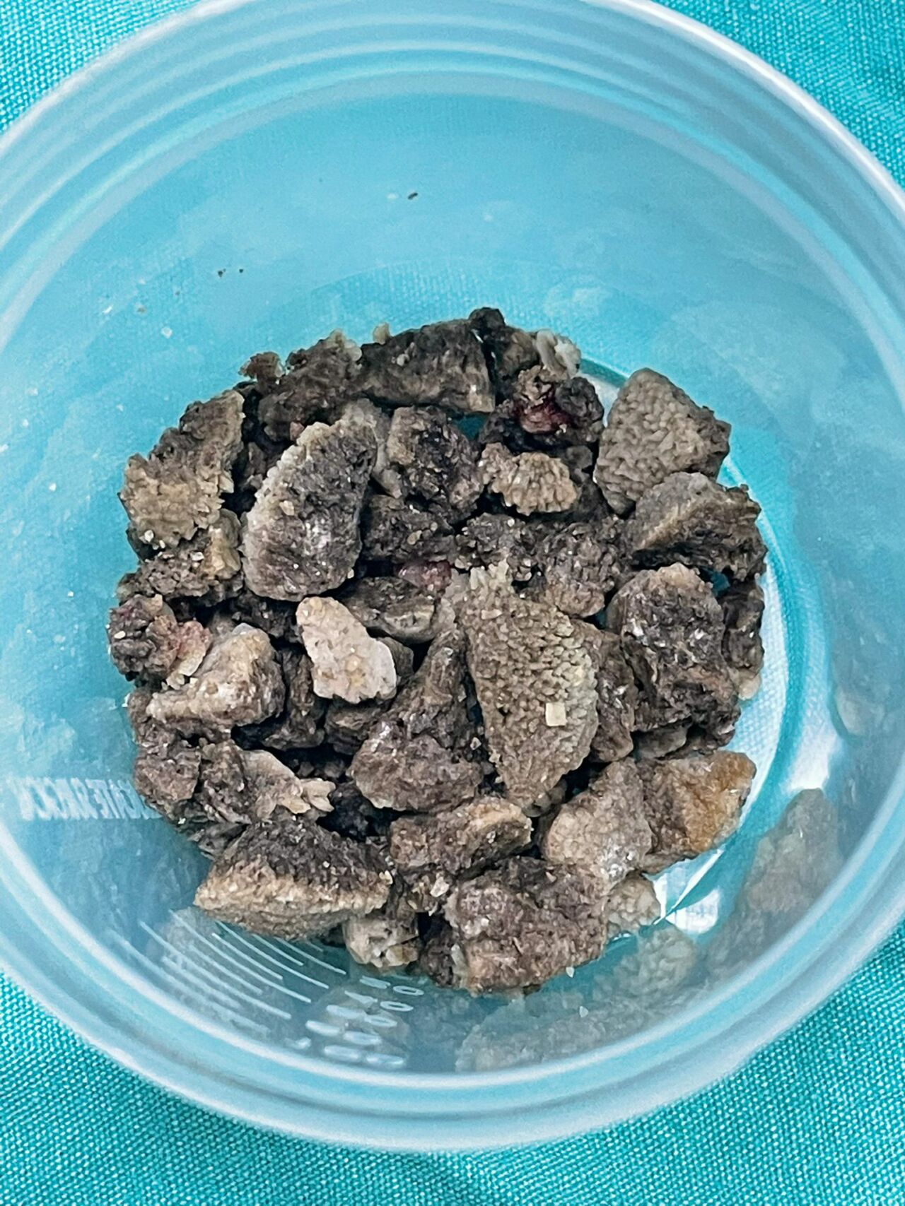Böbrek Taşı MEAH